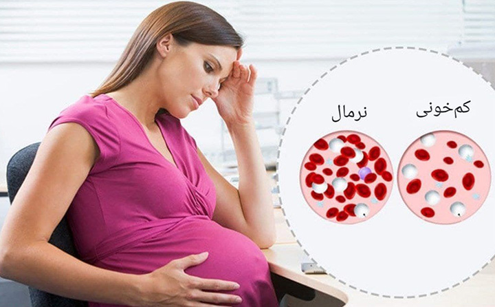علائم کم خونی در بارداری